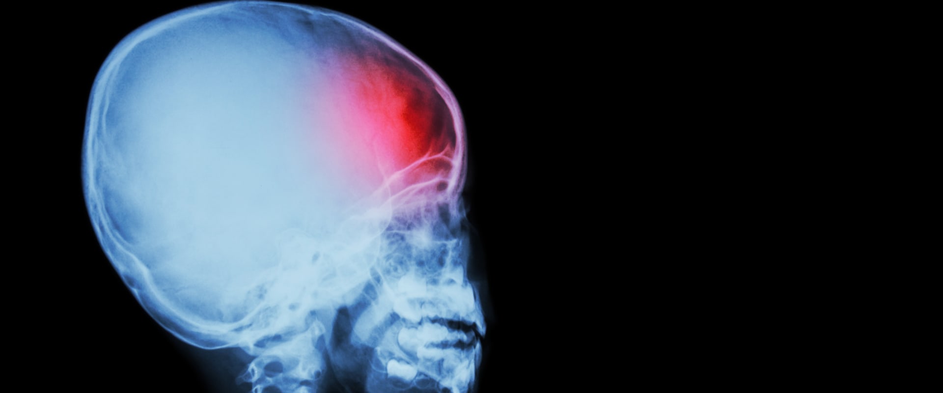 traumatic-brain-injury-treatment-guidelines