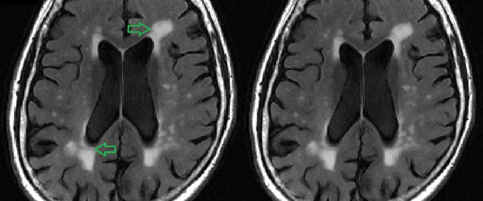 do-old-brain-lesions-appear-on-mri