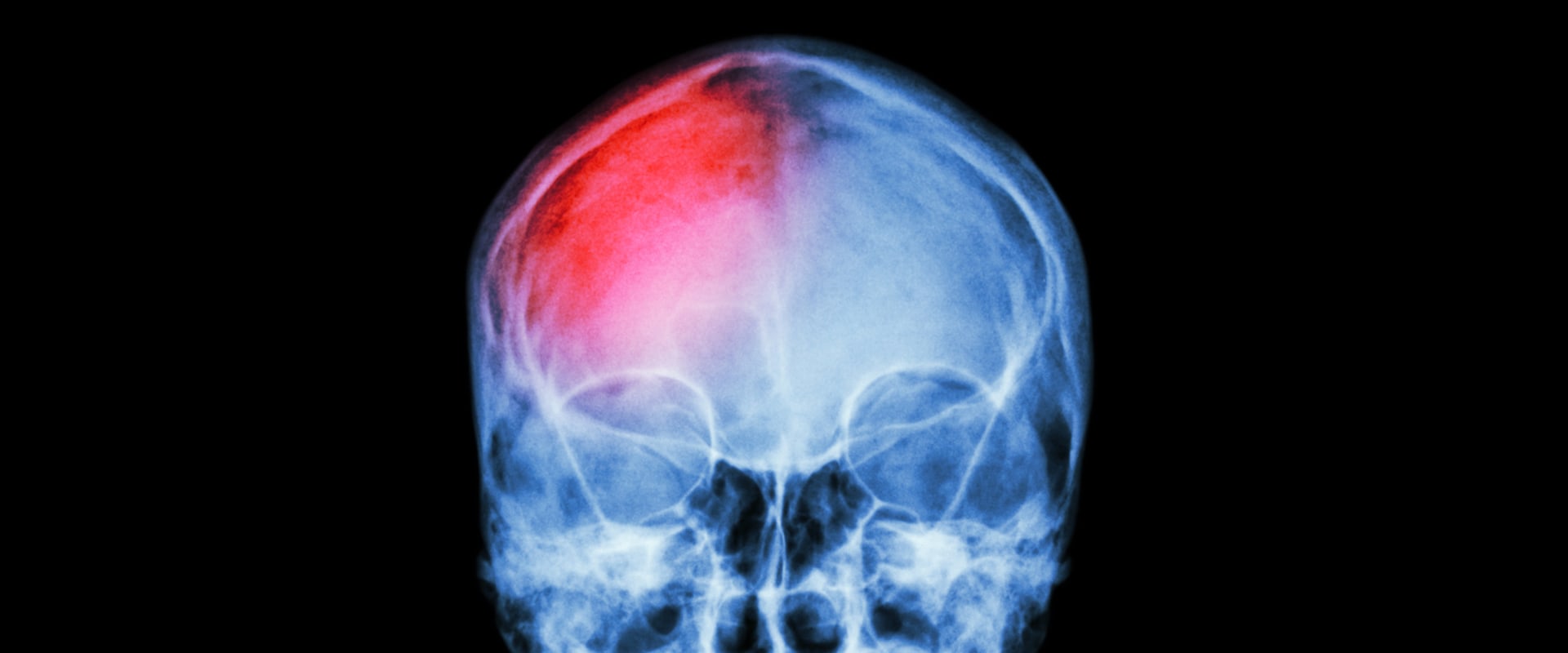 how-is-mild-traumatic-brain-injury-treated