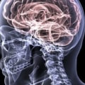 What is considered mild traumatic brain injury?