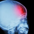 Traumatic brain injury treatment guidelines?