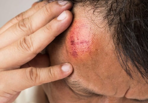 Can a head injury cause symptoms years later?