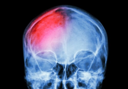 How is mild traumatic brain injury treated?